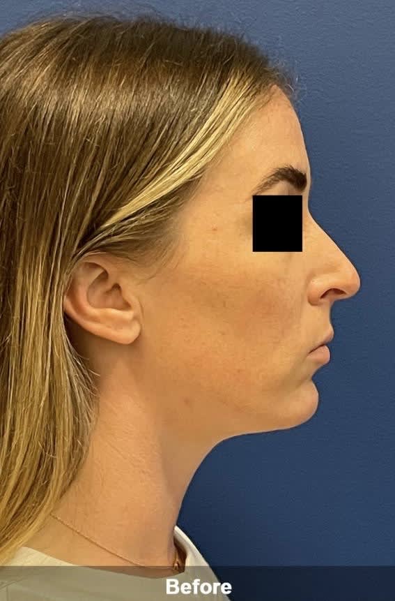 Rhinoplasty Before, Female 34 - 3547