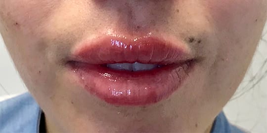 Dermal Fillers & Injectables After, Female 31 - 2631