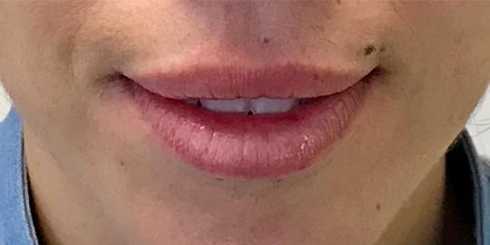Dermal Fillers & Injectables Before, Female 31 - 2631