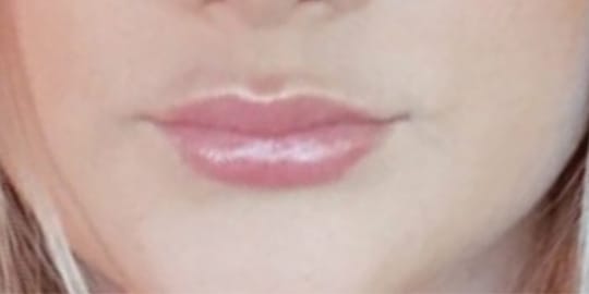 Dermal Fillers & Injectables After, Female 27 - 2633