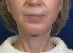 Chin Augmentation After, Female 62 - 2800