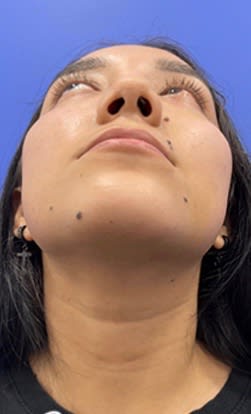 Rhinoplasty After, Female 22 - 3071