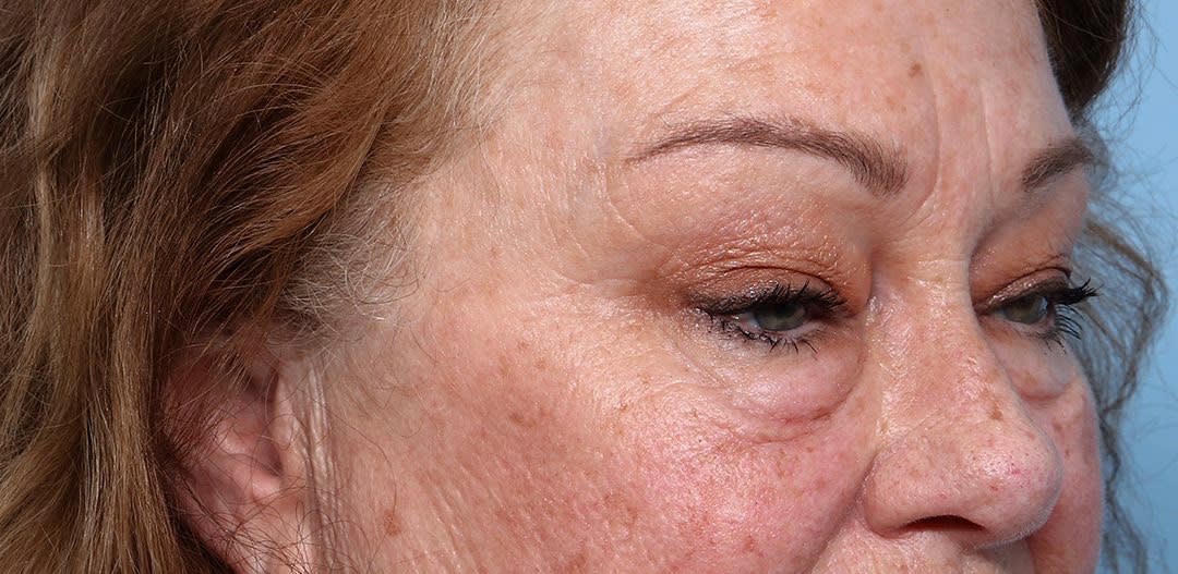 Blepharoplasty Before, Female 65 - 2293