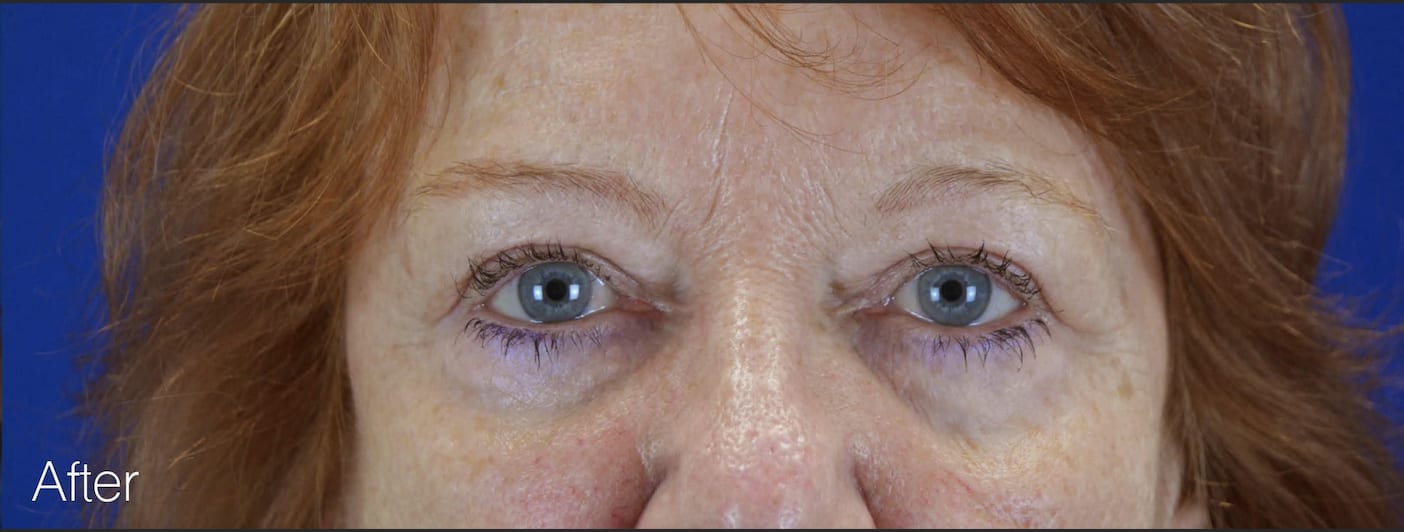 Blepharoplasty After, Female 50 - 3010