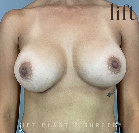 Breast Augmentation (Augmentation Mammaplasty) After, Female 28 - 2672