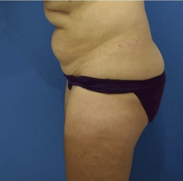 Liposuction Before, Female 48 - 2909