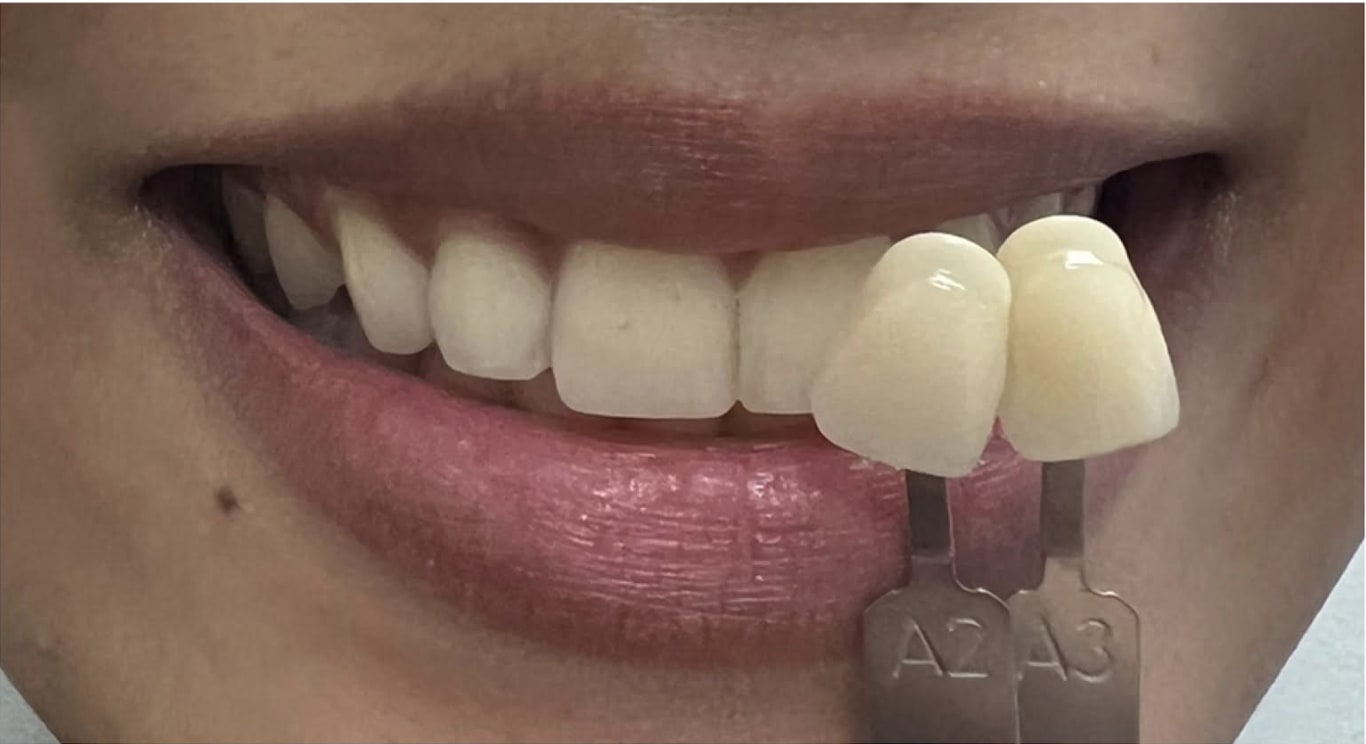 Teeth Whitening After, Female 29 - 4012
