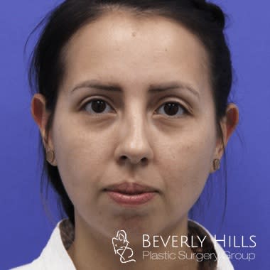 Rhinoplasty Before, Female 32 - 4583