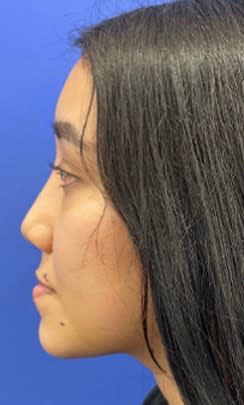 Rhinoplasty After, Female 22 - 3074