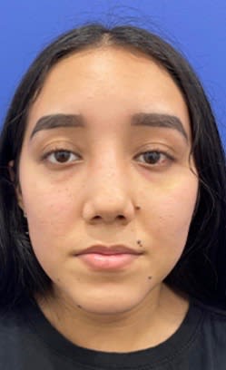 Rhinoplasty After, Female 22 - 3075