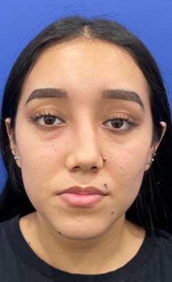 Rhinoplasty Before, Female 22 - 3075