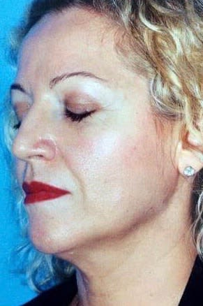 Neck Lift Before, Female 42 - 2168