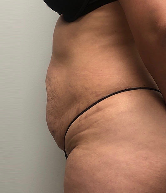 Abdominoplasty Before, Female 32 - 2863