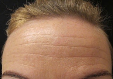 Botox After, Female 37 - 2342