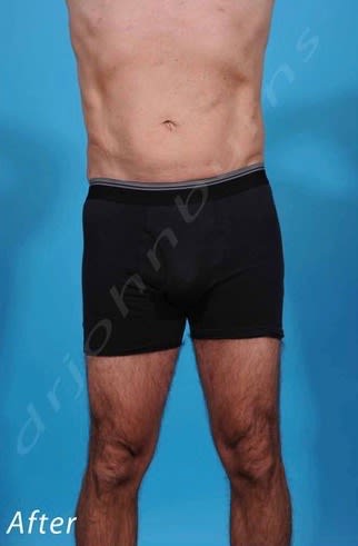 Liposuction After, Male 48 - 2207