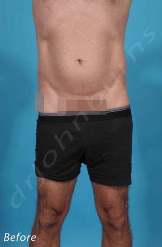 Liposuction Before, Male 48 - 2207