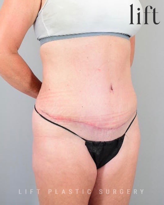 Abdominoplasty After, Female 50 - 2859