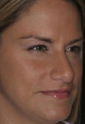 Botox After, Female 32 - 2344