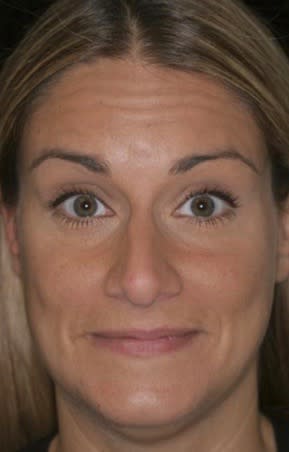 Botox Before, Female 32 - 2343