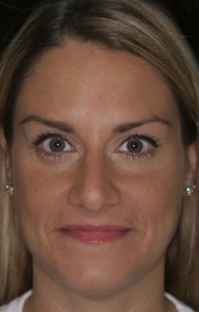 Botox After, Female 32 - 2343
