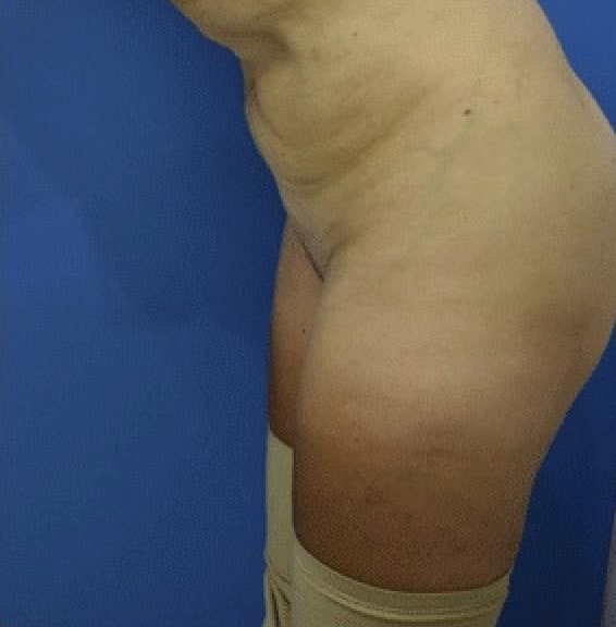 Liposuction After, Female 48 - 2909