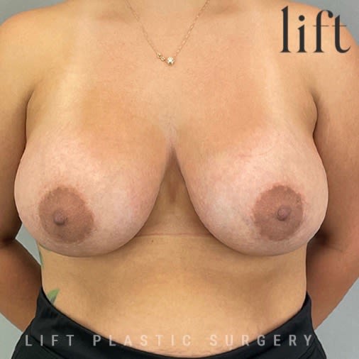 Breast Augmentation (Augmentation Mammaplasty) After, Female 34 - 2673