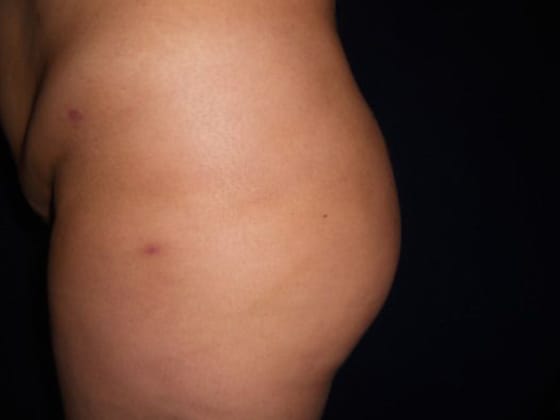 Brazilian Butt Lift After, Female 37 - 3048
