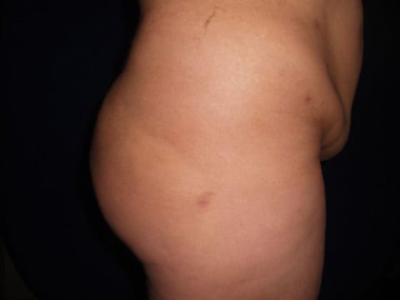 Brazilian Butt Lift After, Female 37 - 3049