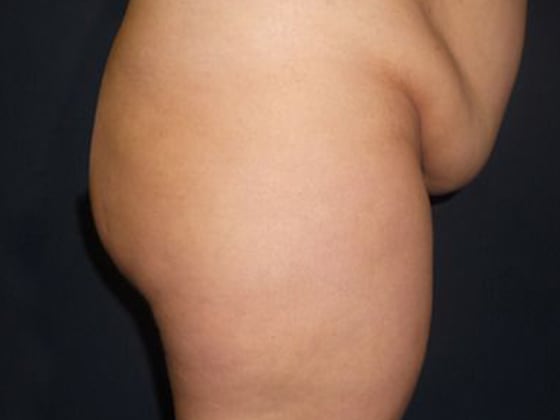Brazilian Butt Lift Before, Female 37 - 3049