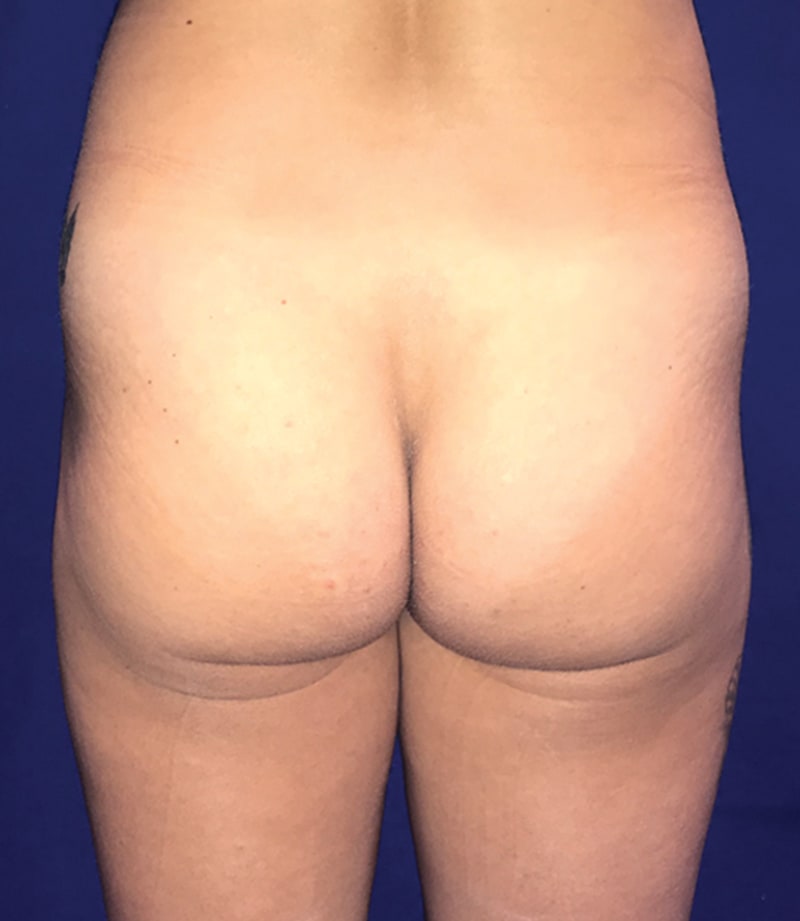 Brazilian Butt Lift Before, Female 41 - 3050