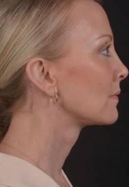 Neck Lift After, Female 51 - 1949