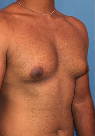 Male Breast Reduction (Gynecomastia Surgery) Before, Male 33 - 2158