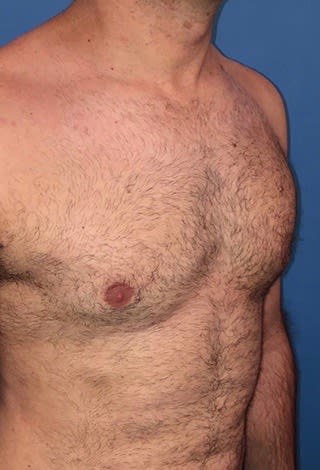 Male Breast Reduction (Gynecomastia Surgery) After, Male 34 - 2159