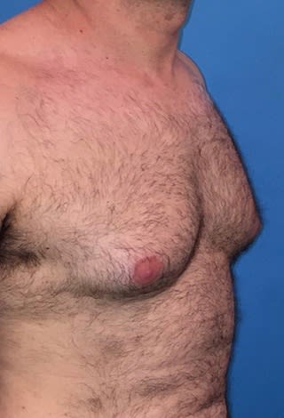 Male Breast Reduction (Gynecomastia Surgery) Before, Male 34 - 2159