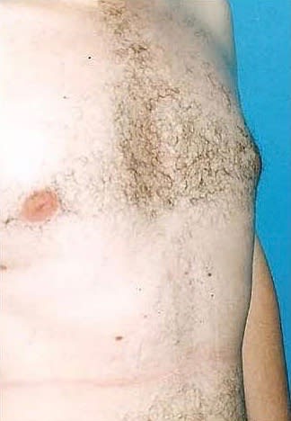 Male Breast Reduction (Gynecomastia Surgery) After, Male 37 - 2160