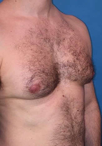 Male Breast Reduction (Gynecomastia Surgery) Before, Male 40 - 2161