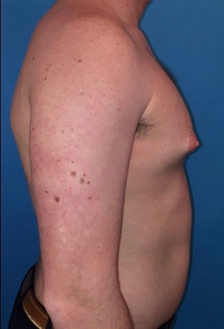 Male Breast Reduction (Gynecomastia Surgery) Before, Male 32 - 2162