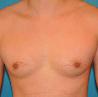Male Breast Reduction (Gynecomastia Surgery) Before, Male 28 - 2164