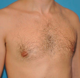Male Breast Reduction (Gynecomastia Surgery) After, Male 33 - 2165