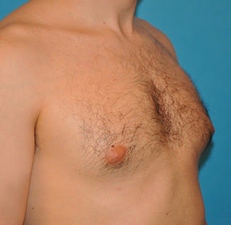 Male Breast Reduction (Gynecomastia Surgery) Before, Male 33 - 2165