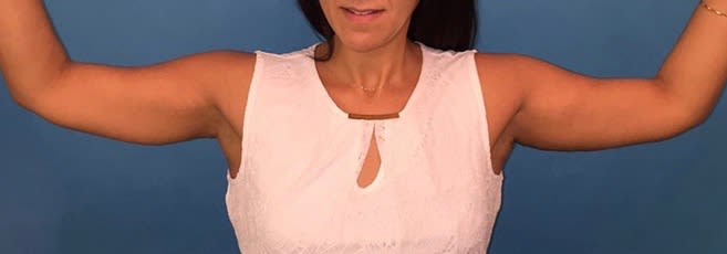 Arm Lift After, Female 56 - 2155