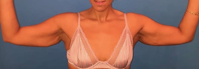 Arm Lift Before, Female 56 - 2155