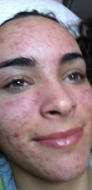 Acne Scar Solutions Before, Female 28 - 2339