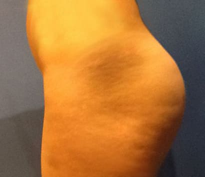 Brazilian Butt Lift After, Female 24 - 3052