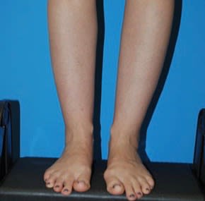 Liposuction Before, Female 34 - 2913