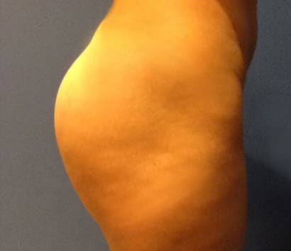 Brazilian Butt Lift After, Female 24 - 3053