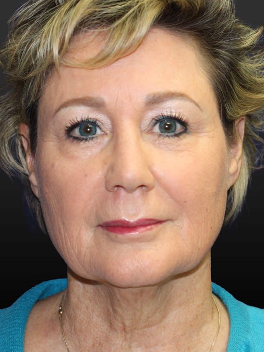 Facial Fat Grafting Before, Female 57 - 3433