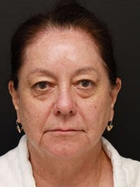 Facial Fat Grafting Before, Female 58 - 3431