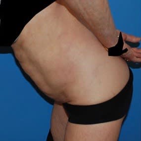 Liposuction After, Female 58 - 2917