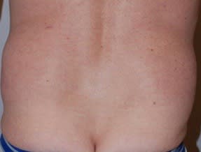 Liposuction Before, Male 38 - 2923